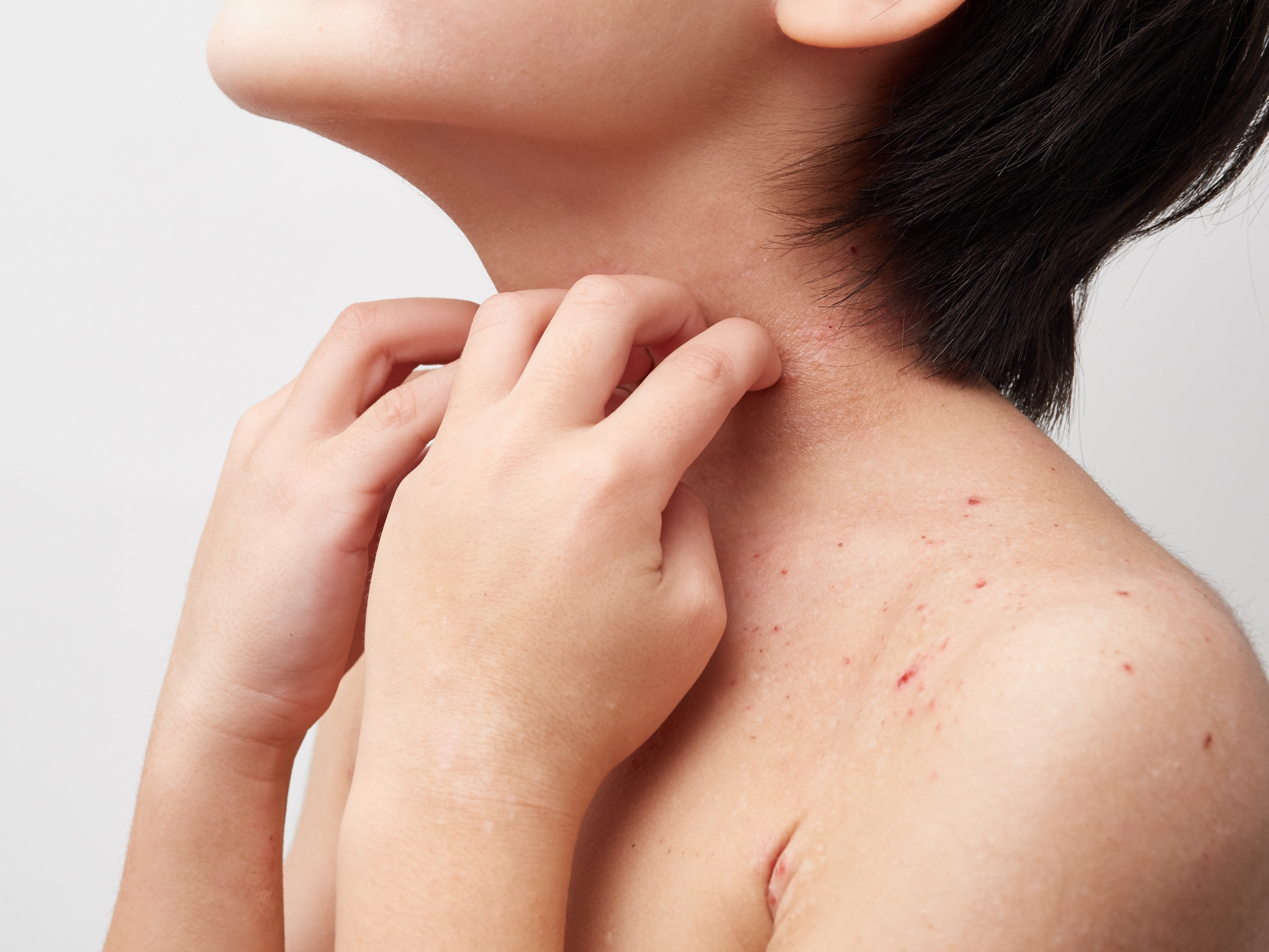 アトピー性皮膚炎の原因